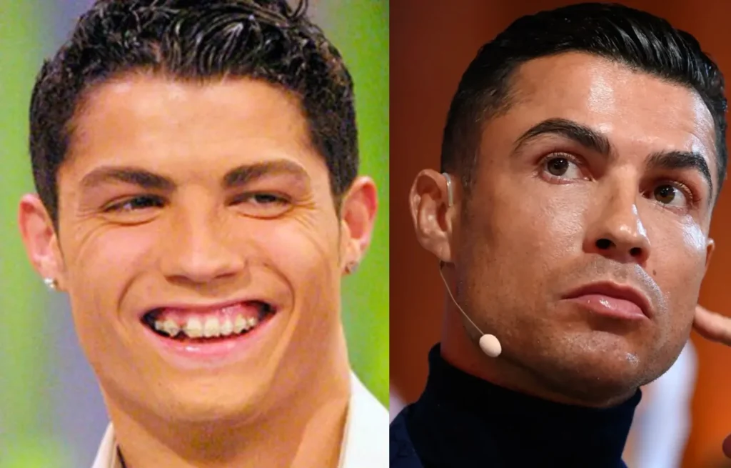 Cristiano Ronaldo de Joven y su cambios físicos y cirugías estéticas